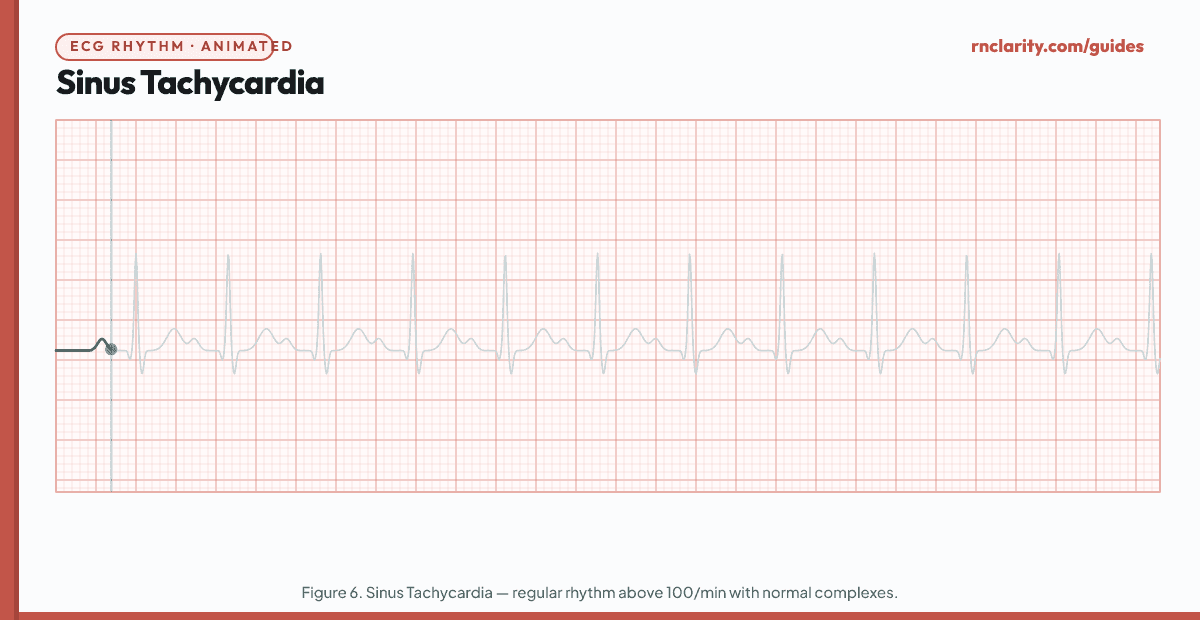 Animated ECG strip showing Sinus Tachycardia: regular rhythm with rate above 100 per minute, upright P waves, narrow QRS complexes, shortened R-R intervals, PR interval normal or slightly short.