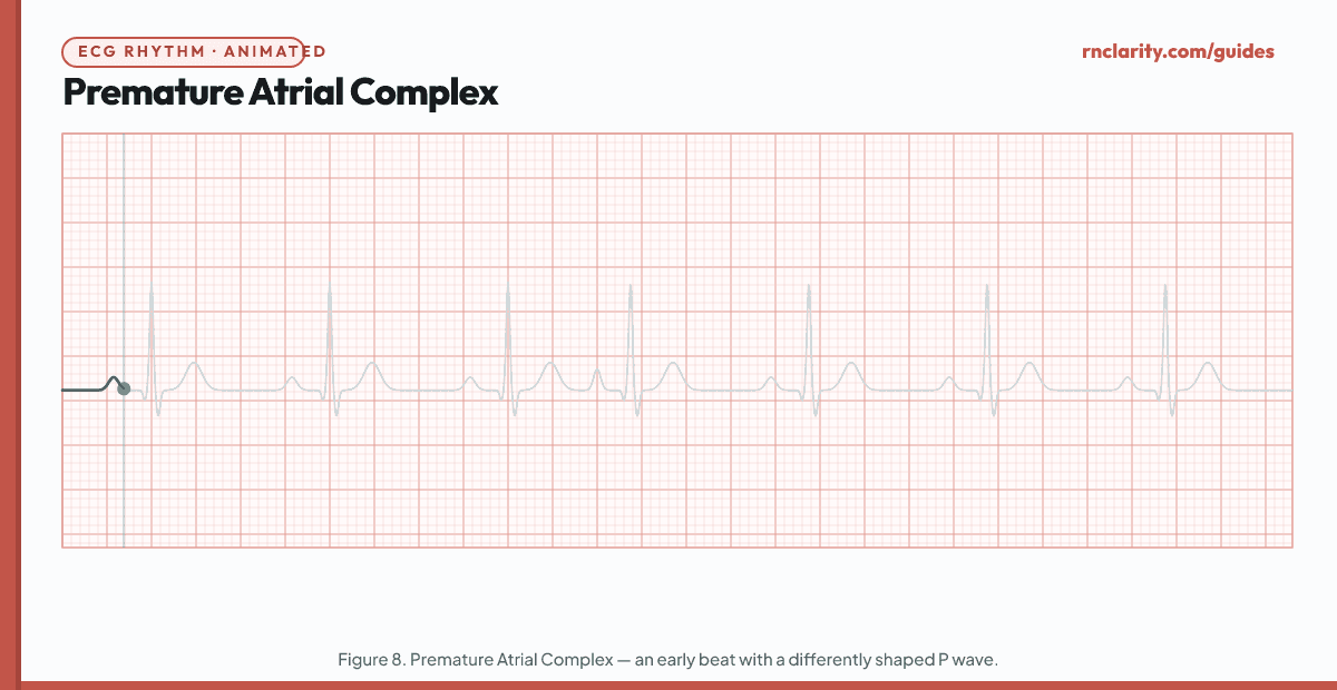 Animated ECG strip showing Premature Atrial Complex (PAC): underlying sinus rhythm with an early beat that has a differently shaped P wave (notched or biphasic), narrow QRS, followed by a non-compensatory pause before the next sinus beat.