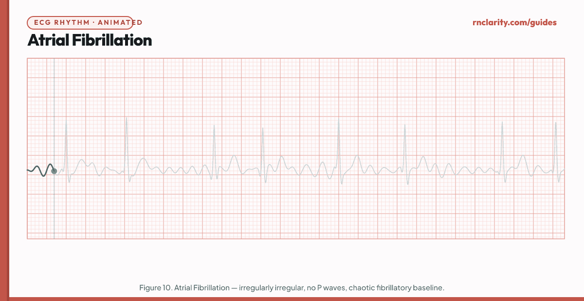 Animated ECG strip showing Atrial Fibrillation: irregularly irregular ventricular rhythm, no discernible P waves replaced by chaotic fibrillatory baseline, narrow QRS complexes varying in timing with no consistent R-R intervals.