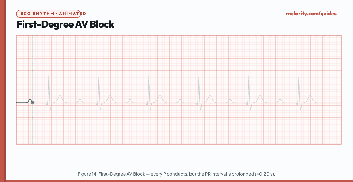 Animated ECG strip showing First-Degree AV Block: regular rhythm, every P wave is followed by a QRS, PR interval consistently prolonged greater than 0.20 seconds (more than one large square), narrow QRS complexes.