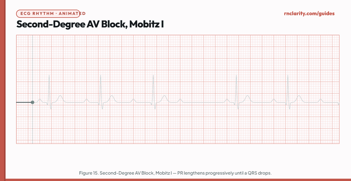 Animated ECG strip showing Second-Degree AV Block Type I (Wenckebach/Mobitz I): regular P waves but PR interval progressively lengthens from beat to beat until one P wave fails to conduct and the QRS is dropped, then the cycle resets.