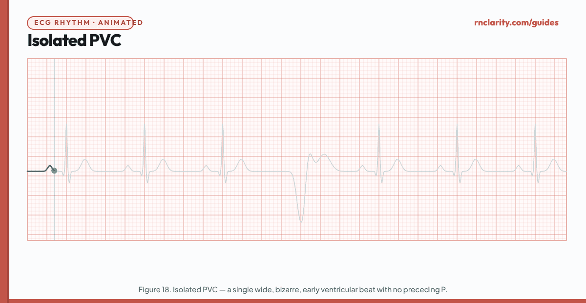Animated ECG strip showing an Isolated Premature Ventricular Complex (PVC): underlying sinus rhythm with a single early, wide (greater than 0.12 seconds) and bizarrely shaped QRS without a preceding P wave, followed by a full compensatory pause before the next sinus beat.