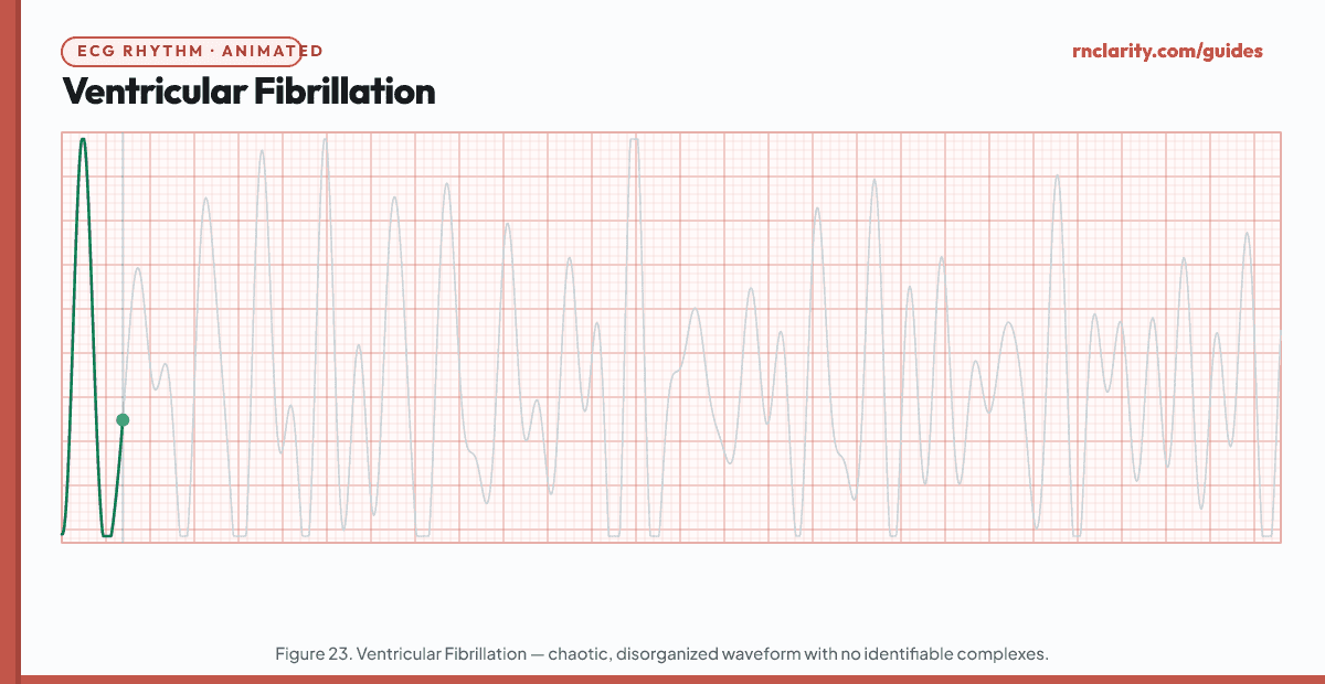 Animated ECG strip showing Ventricular Fibrillation: completely chaotic, irregular, undulating waveform with no recognizable P waves, QRS complexes, or T waves — coarse VF shows large deflections, fine VF shows small, irregular trembling waveform.