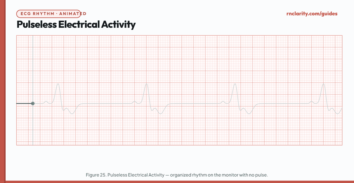 Animated ECG strip showing Pulseless Electrical Activity (PEA): organized-appearing ECG rhythm (may resemble sinus rhythm, idioventricular rhythm, or another recognizable pattern) but the client has no palpable pulse and no cardiac output — the electrical activity does not produce effective mechanical contraction.