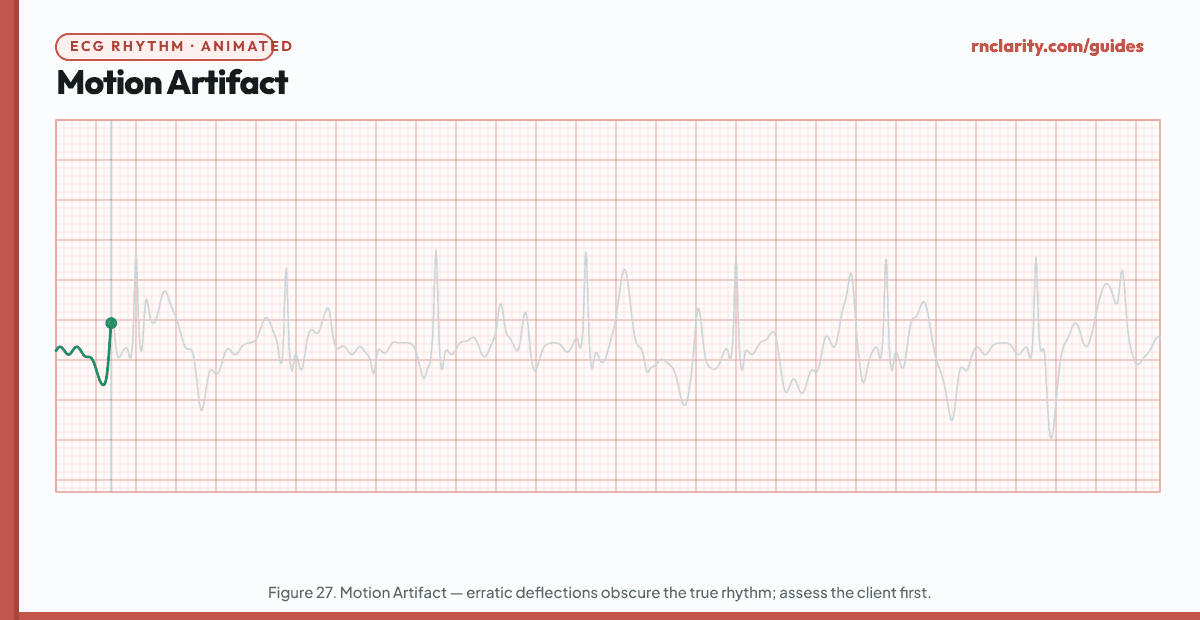 Animated ECG strip showing Motion Artifact: grossly irregular, erratic large-amplitude deflections that obscure all true waveforms for a portion of the strip, followed by return of the true underlying rhythm once movement stops — demonstrating that the apparent dysrhythmia is artifact, not a true rhythm change.